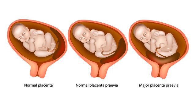 Placenta praevia