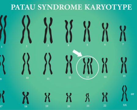 Patauův syndrom